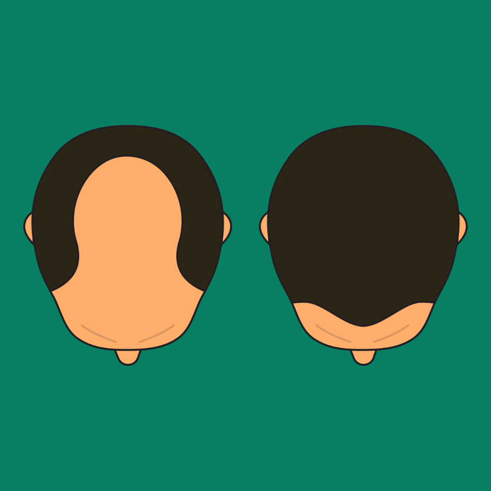 A New Hair Loss Treatment Backed by Google Ventures Might Finally Make Baldness a Thing of the Past